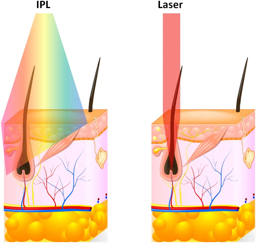 Unterschied IPL zu Laser