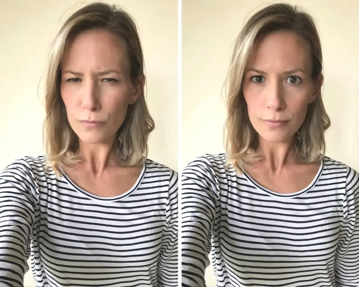 Botox Behandlung nachher in St. Gallen